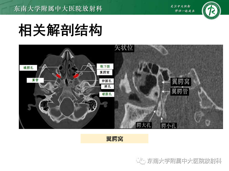 影像PPT - 【PPT】颌面部横纹肌肉瘤-7