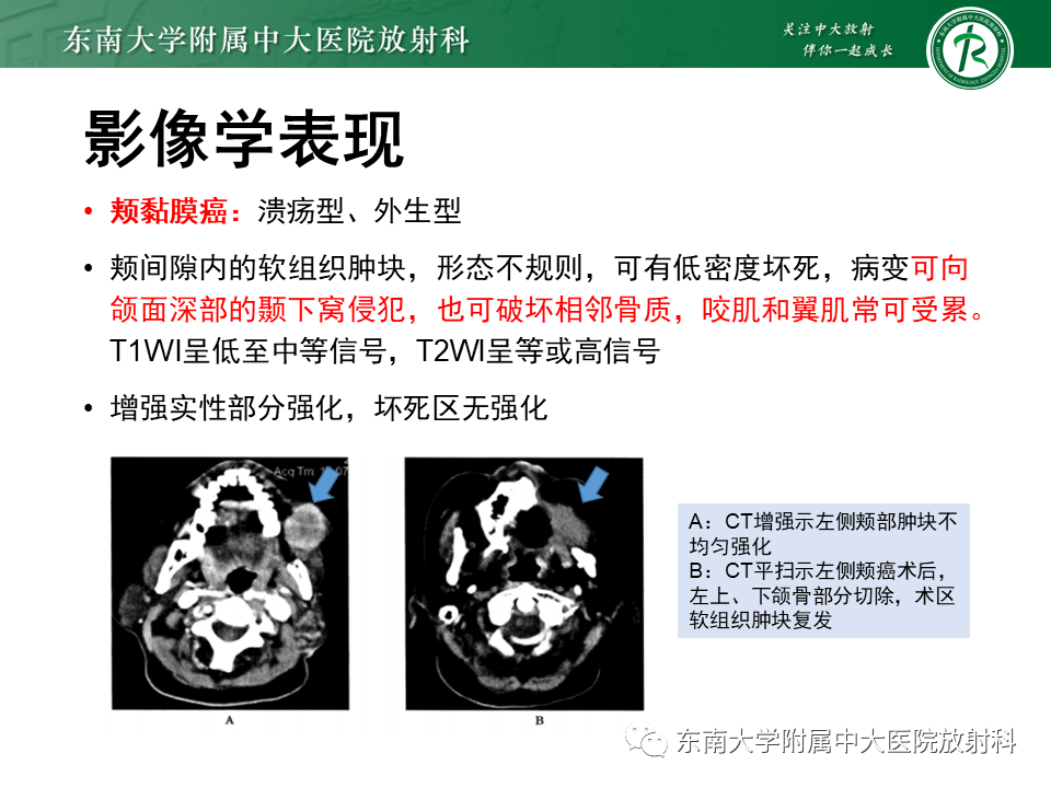 影像PPT - 【PPT】颌面部横纹肌肉瘤-16