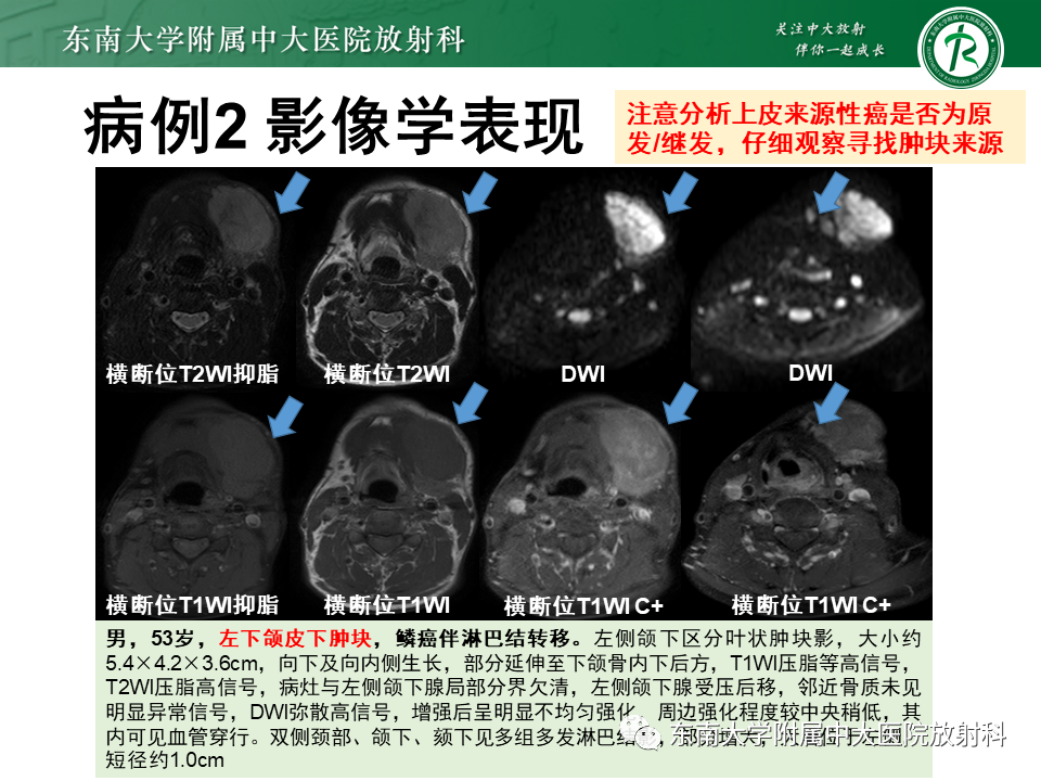 影像PPT - 【PPT】颌面部横纹肌肉瘤-19