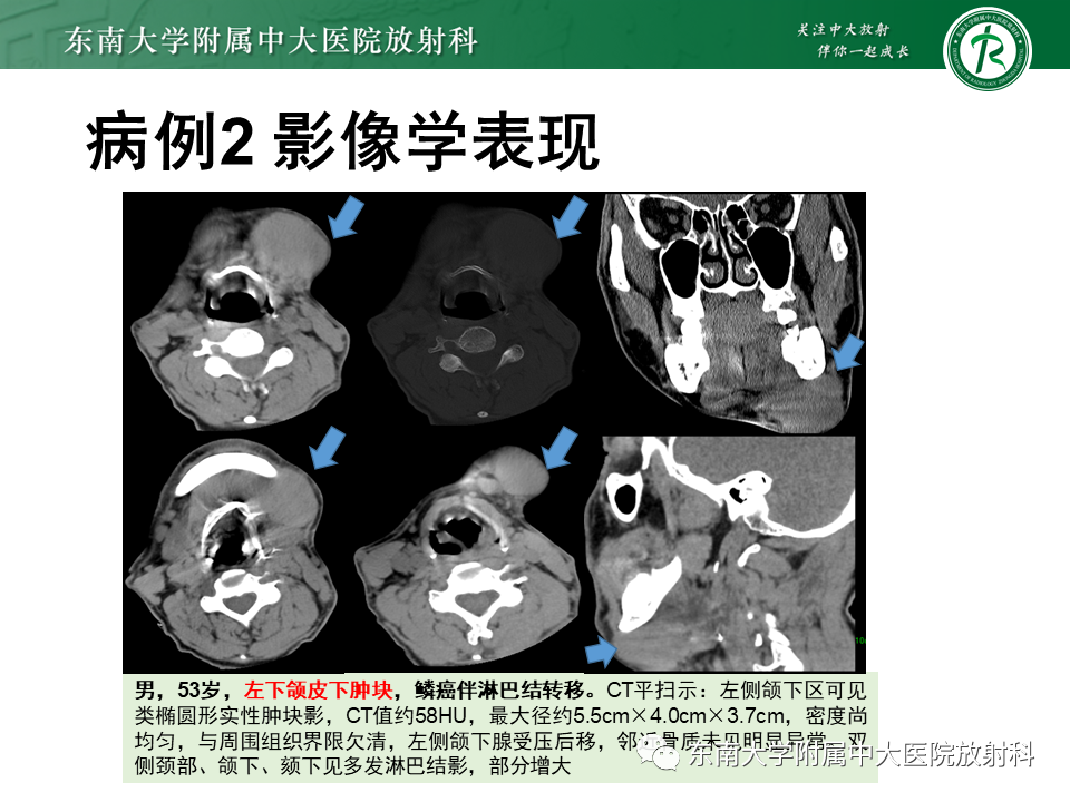 影像PPT - 【PPT】颌面部横纹肌肉瘤-18