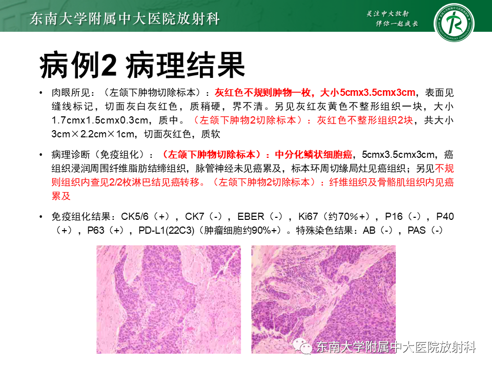 影像PPT - 【PPT】颌面部横纹肌肉瘤-20