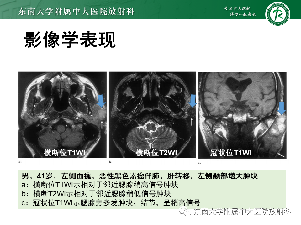 影像PPT - 【PPT】颌面部横纹肌肉瘤-25