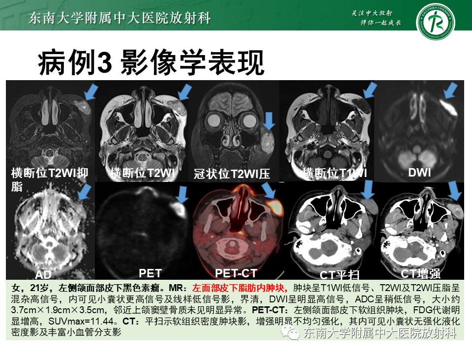 影像PPT - 【PPT】颌面部横纹肌肉瘤-27