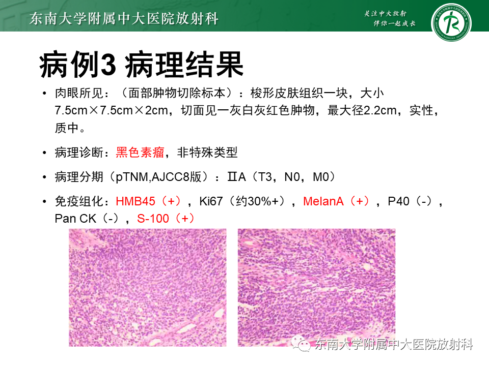 影像PPT - 【PPT】颌面部横纹肌肉瘤-28
