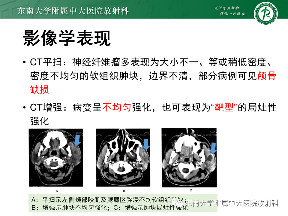 影像PPT - 【PPT】颌面部横纹肌肉瘤-31