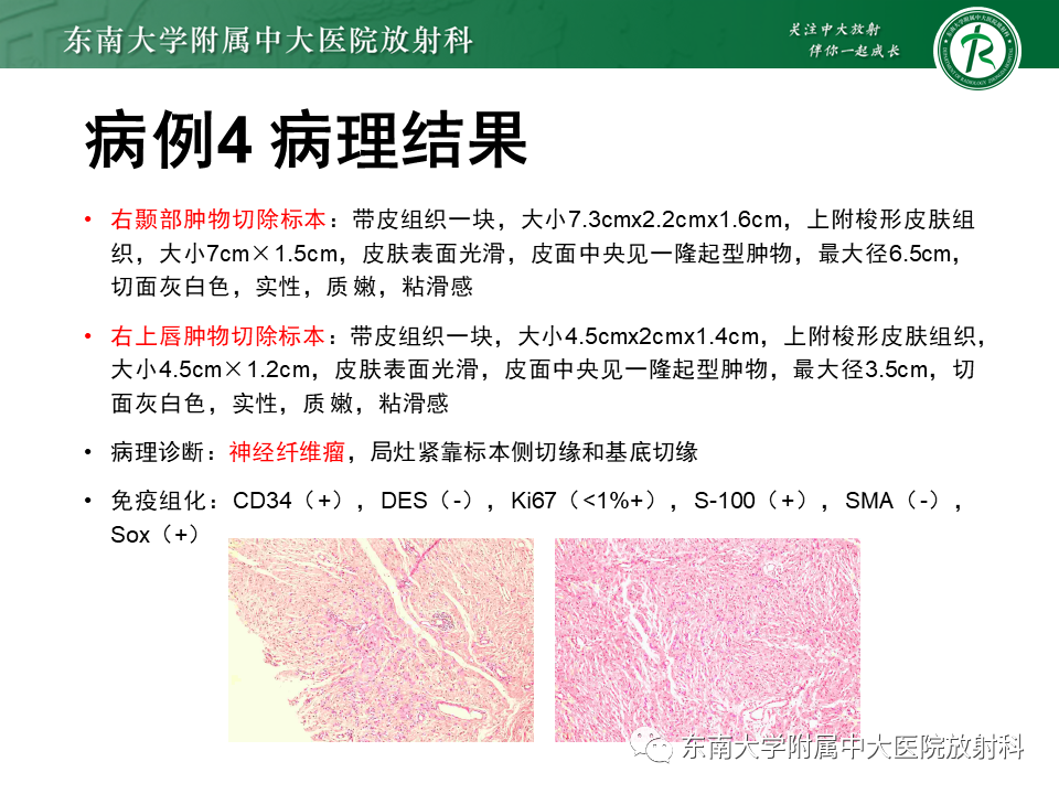 影像PPT - 【PPT】颌面部横纹肌肉瘤-35