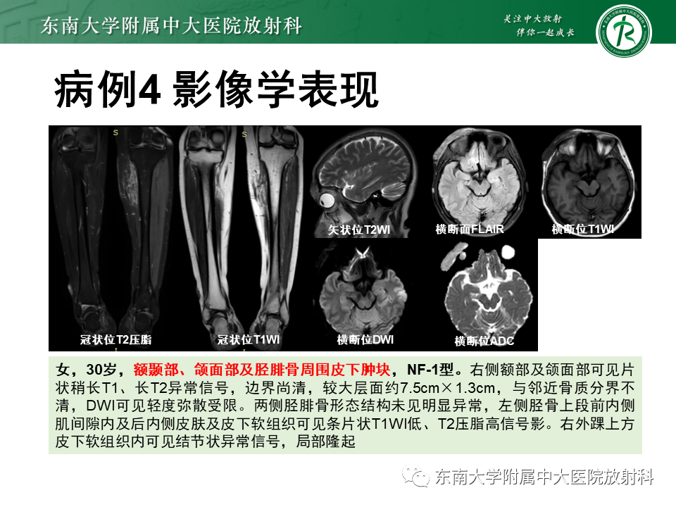 影像PPT - 【PPT】颌面部横纹肌肉瘤-34