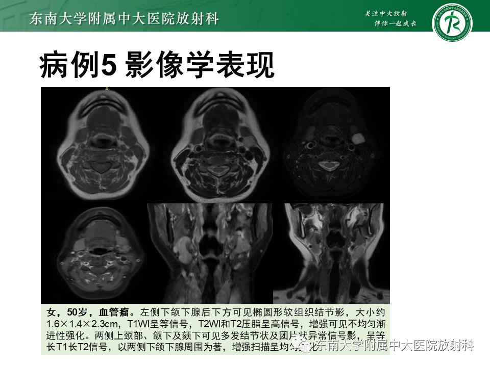 影像PPT - 【PPT】颌面部横纹肌肉瘤-39