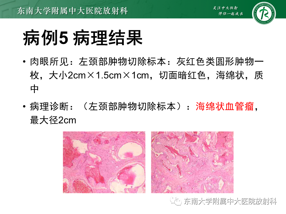 影像PPT - 【PPT】颌面部横纹肌肉瘤-40