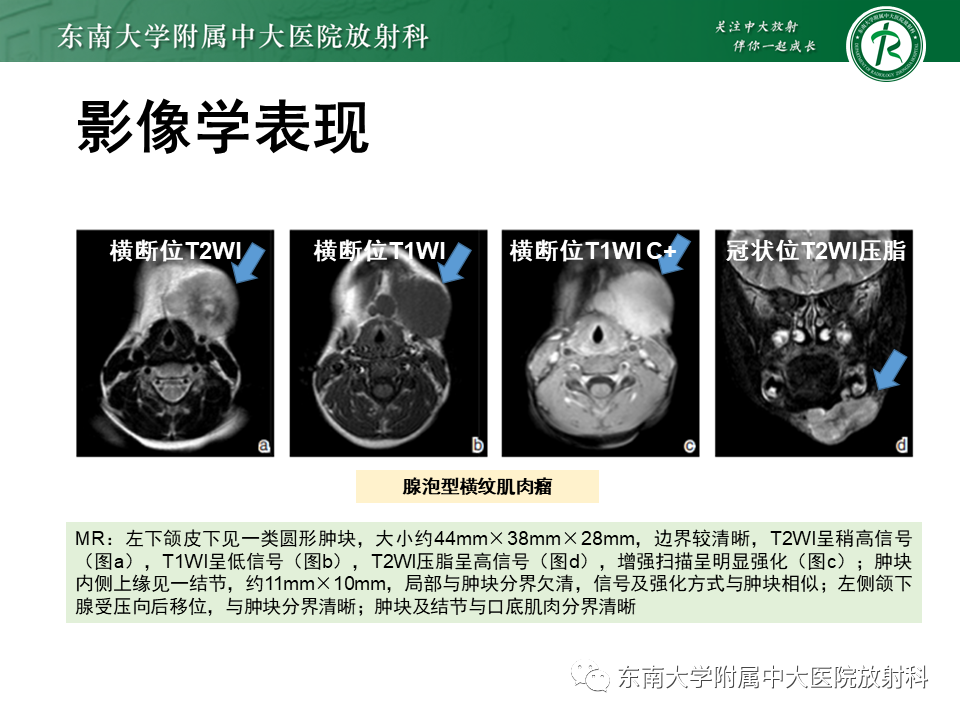 影像PPT - 【PPT】颌面部横纹肌肉瘤-2