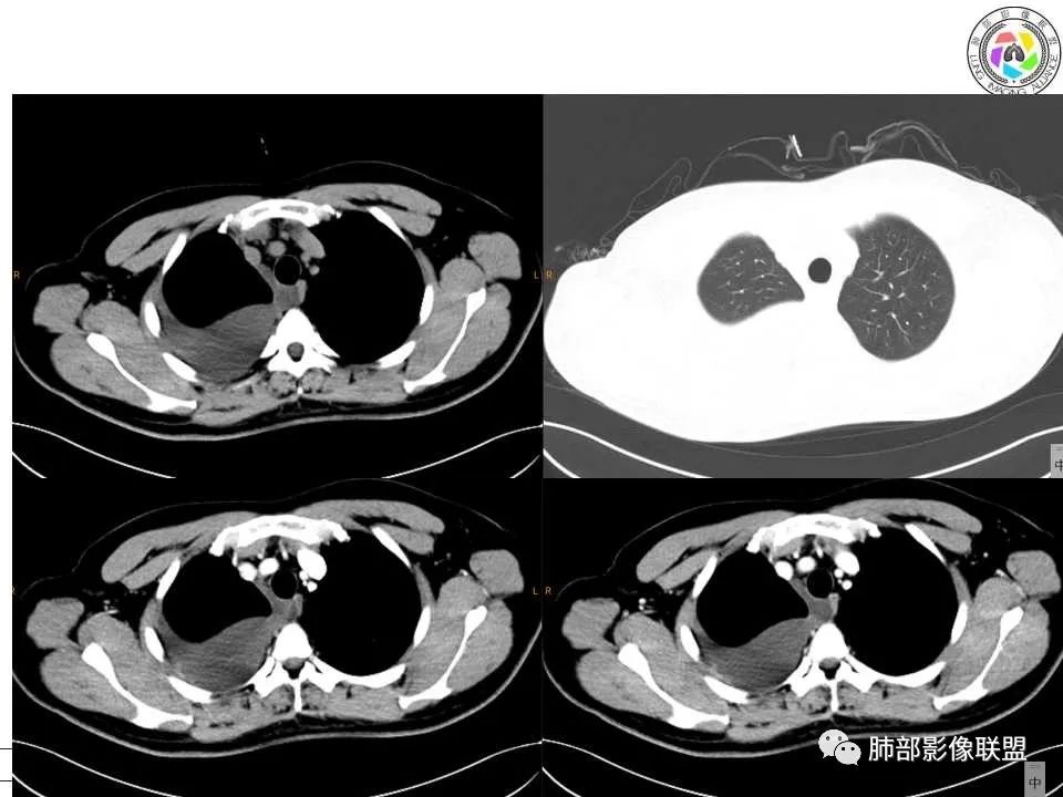 影像PPT - 【病例】纵隔恶性黑色素瘤1例CT影像-3 影像PPT - 【病例】纵隔恶性黑色素瘤1例CT影像-3