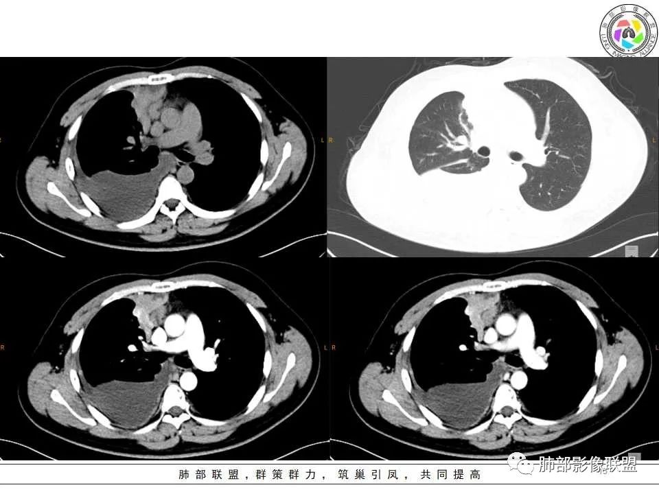 影像PPT - 【病例】纵隔恶性黑色素瘤1例CT影像-15 影像PPT - 【病例】纵隔恶性黑色素瘤1例CT影像-15