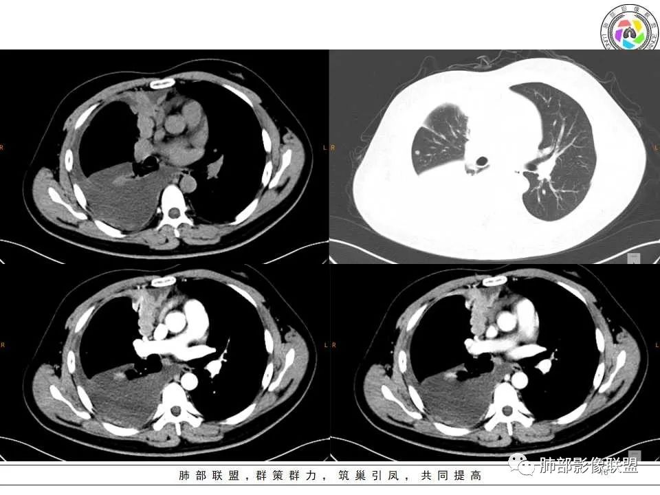 影像PPT - 【病例】纵隔恶性黑色素瘤1例CT影像-18 影像PPT - 【病例】纵隔恶性黑色素瘤1例CT影像-18