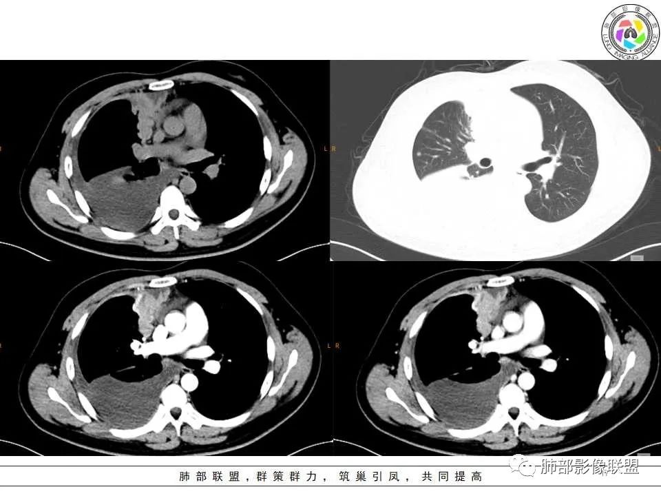 影像PPT - 【病例】纵隔恶性黑色素瘤1例CT影像-17 影像PPT - 【病例】纵隔恶性黑色素瘤1例CT影像-17