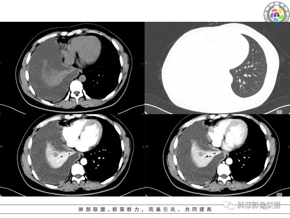 影像PPT - 【病例】纵隔恶性黑色素瘤1例CT影像-30 影像PPT - 【病例】纵隔恶性黑色素瘤1例CT影像-30