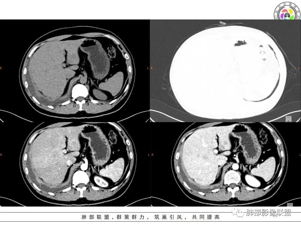 影像PPT - 【病例】纵隔恶性黑色素瘤1例CT影像-36 影像PPT - 【病例】纵隔恶性黑色素瘤1例CT影像-36