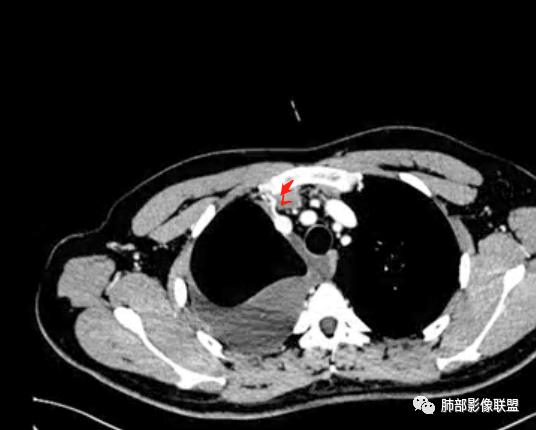 影像PPT - 【病例】纵隔恶性黑色素瘤1例CT影像-39 影像PPT - 【病例】纵隔恶性黑色素瘤1例CT影像-39