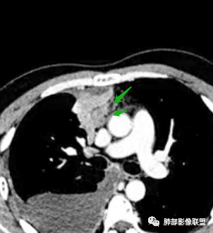影像PPT - 【病例】纵隔恶性黑色素瘤1例CT影像-43 影像PPT - 【病例】纵隔恶性黑色素瘤1例CT影像-43