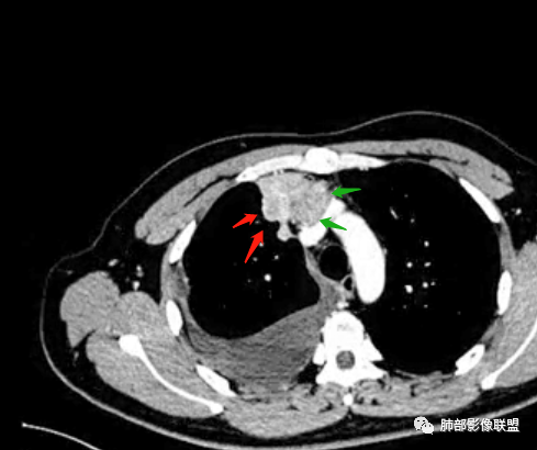 影像PPT - 【病例】纵隔恶性黑色素瘤1例CT影像-41 影像PPT - 【病例】纵隔恶性黑色素瘤1例CT影像-41