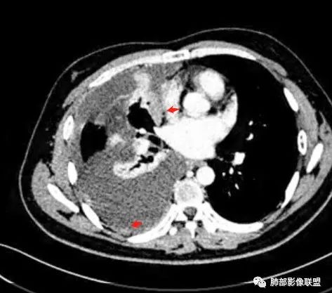 影像PPT - 【病例】纵隔恶性黑色素瘤1例CT影像-45 影像PPT - 【病例】纵隔恶性黑色素瘤1例CT影像-45