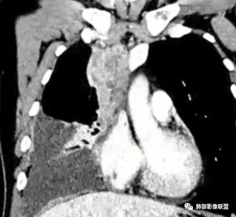 影像PPT - 【病例】纵隔恶性黑色素瘤1例CT影像-56 影像PPT - 【病例】纵隔恶性黑色素瘤1例CT影像-56
