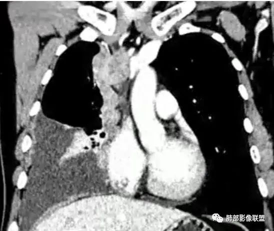 影像PPT - 【病例】纵隔恶性黑色素瘤1例CT影像-59 影像PPT - 【病例】纵隔恶性黑色素瘤1例CT影像-59