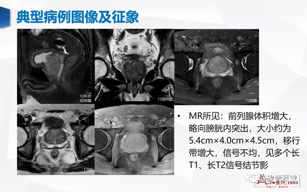 影像PPT - 【PPT】前列腺病变鉴别-4