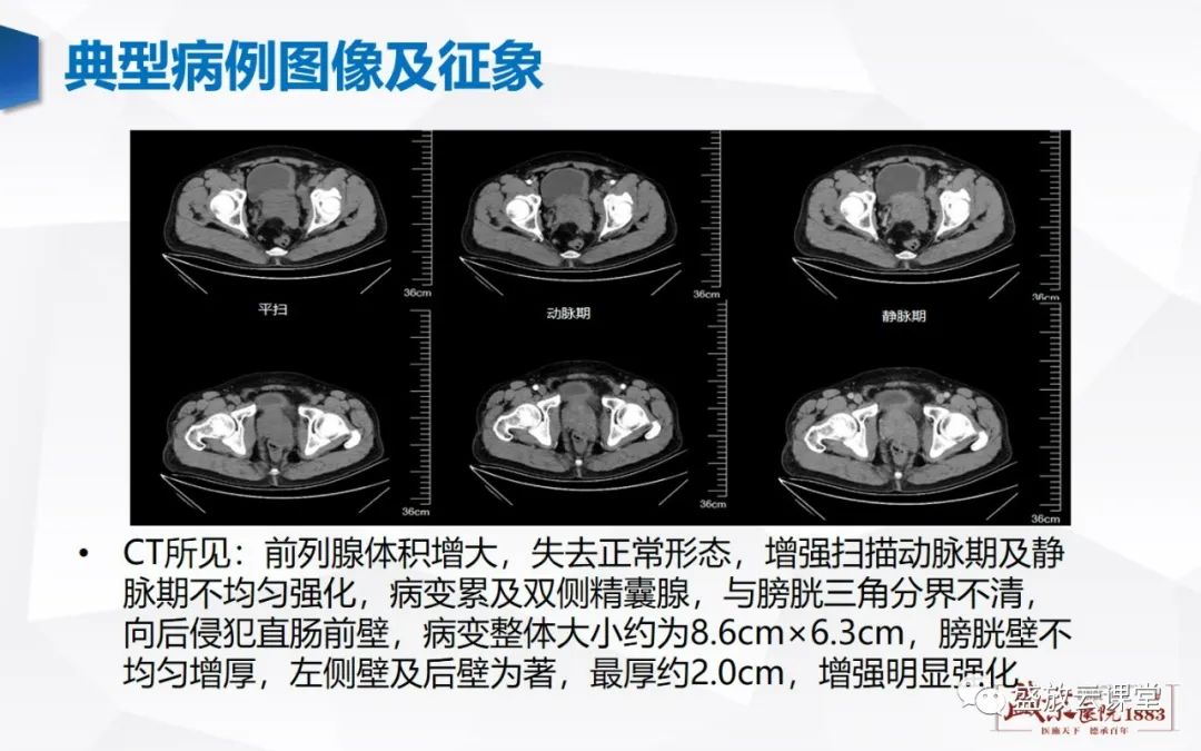 影像PPT - 【PPT】前列腺病变鉴别-10