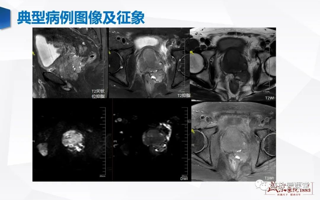 影像PPT - 【PPT】前列腺病变鉴别-11