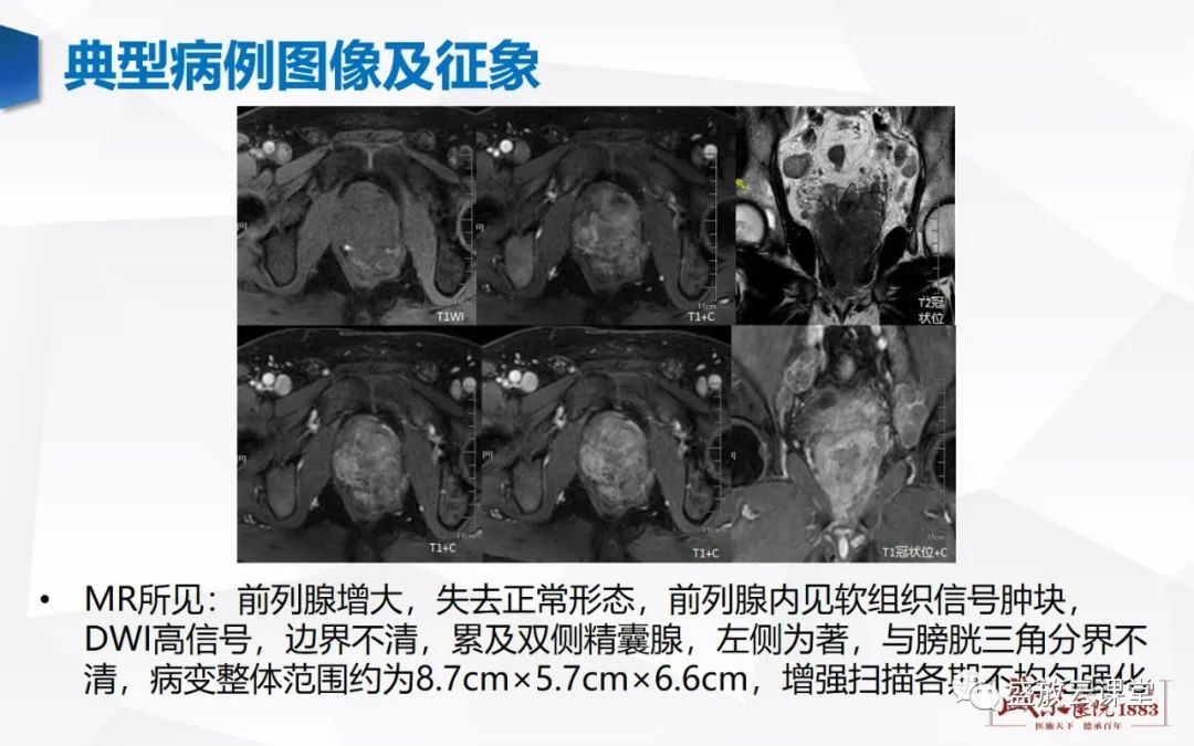 影像PPT - 【PPT】前列腺病变鉴别-12