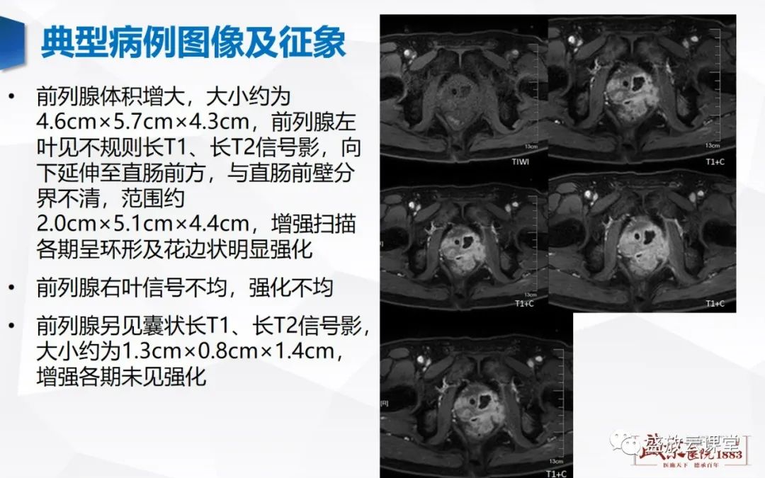 影像PPT - 【PPT】前列腺病变鉴别-20