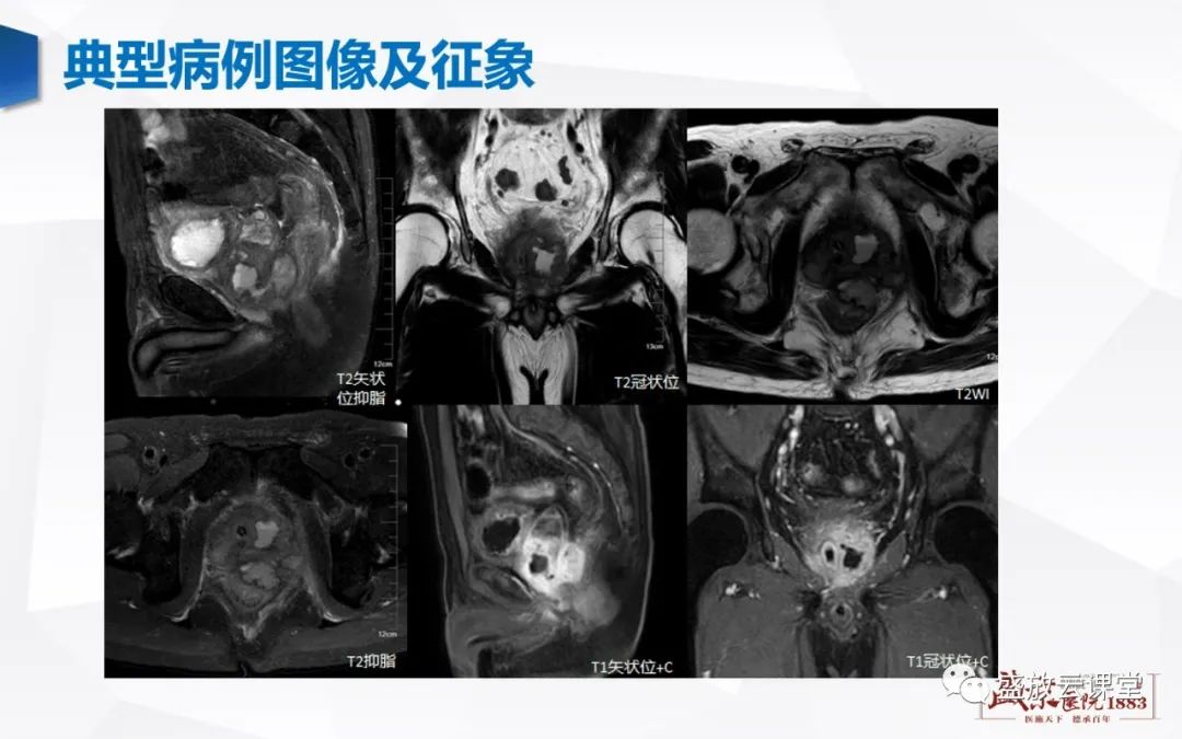 影像PPT - 【PPT】前列腺病变鉴别-19