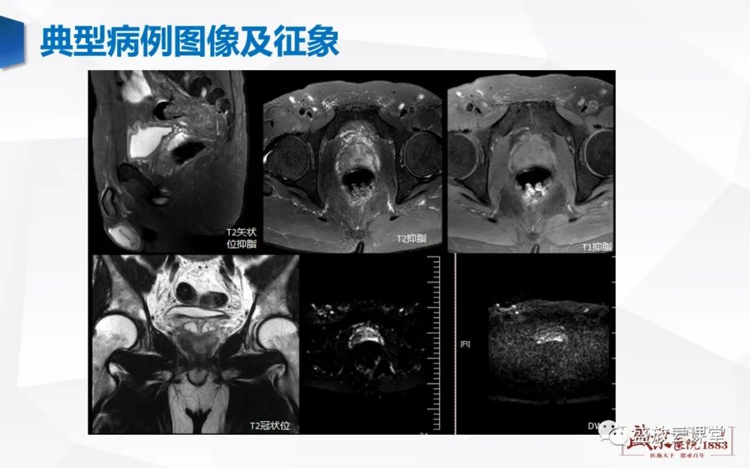 影像PPT - 【PPT】前列腺病变鉴别-25