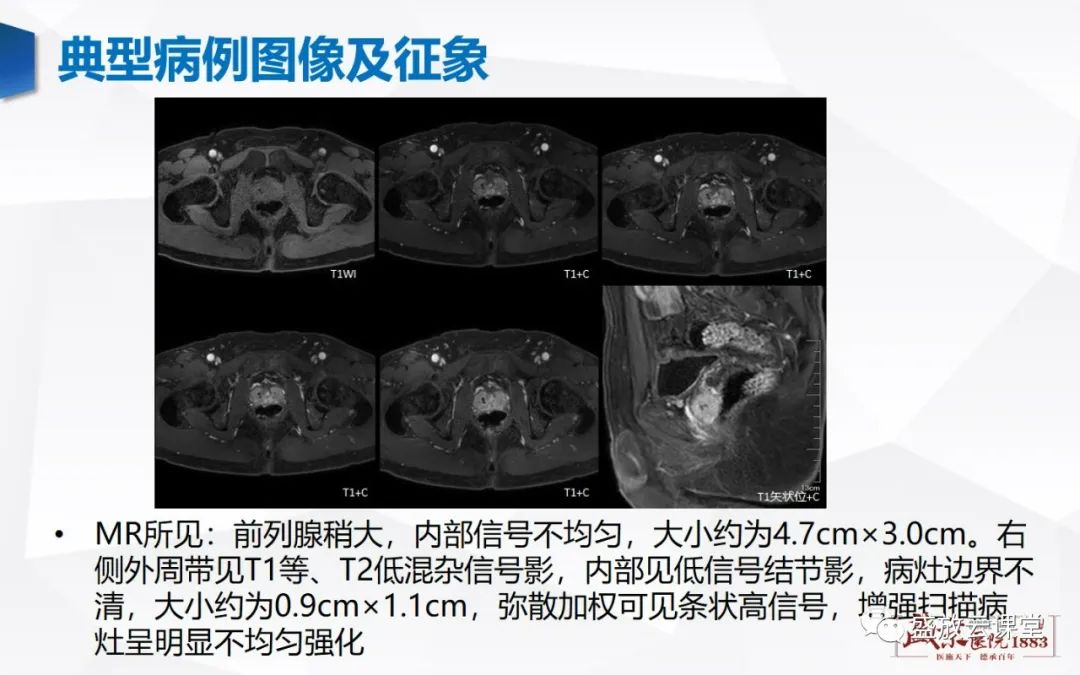 影像PPT - 【PPT】前列腺病变鉴别-26