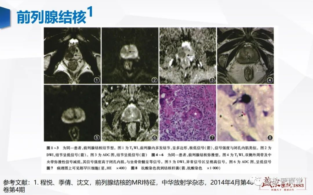 影像PPT - 【PPT】前列腺病变鉴别-23