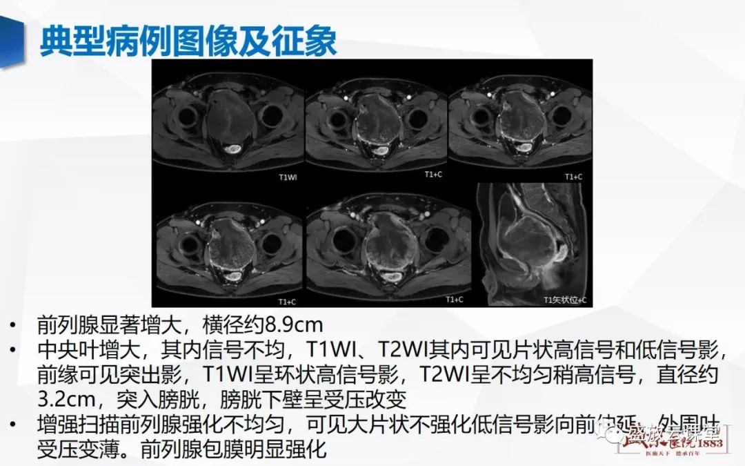 影像PPT - 【PPT】前列腺病变鉴别-31