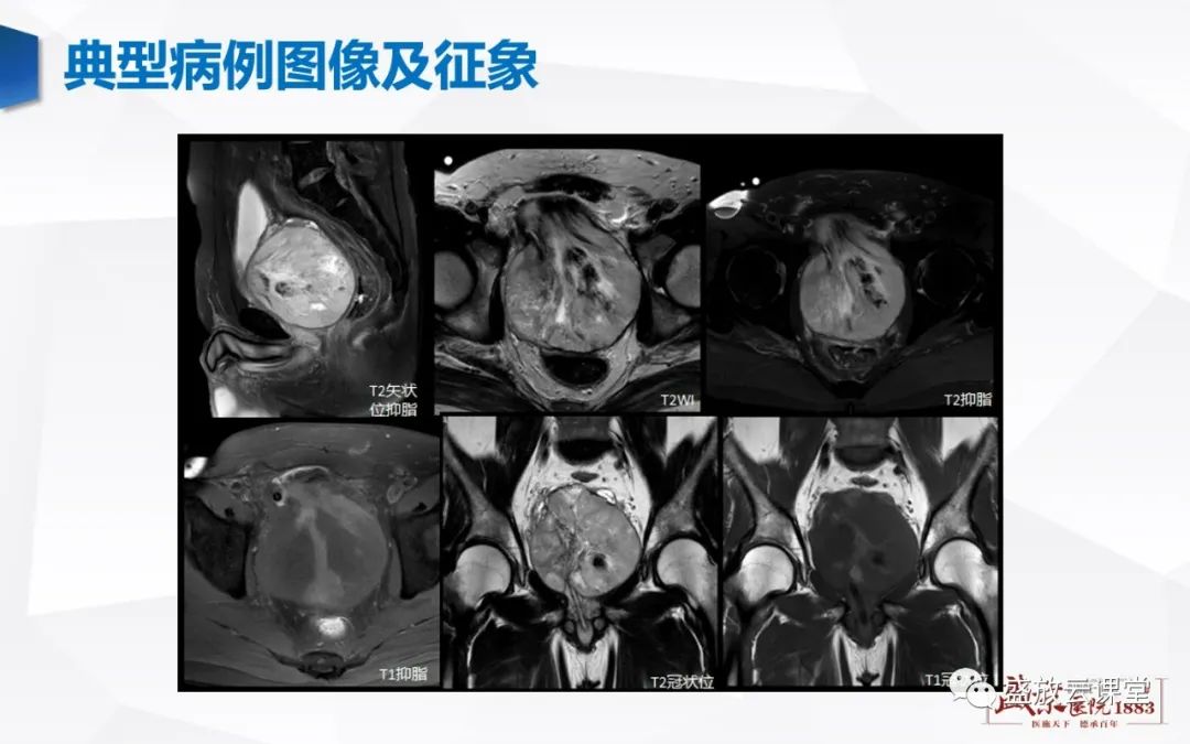 影像PPT - 【PPT】前列腺病变鉴别-30