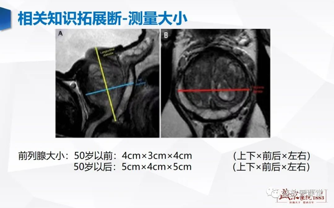 影像PPT - 【PPT】前列腺病变鉴别-39