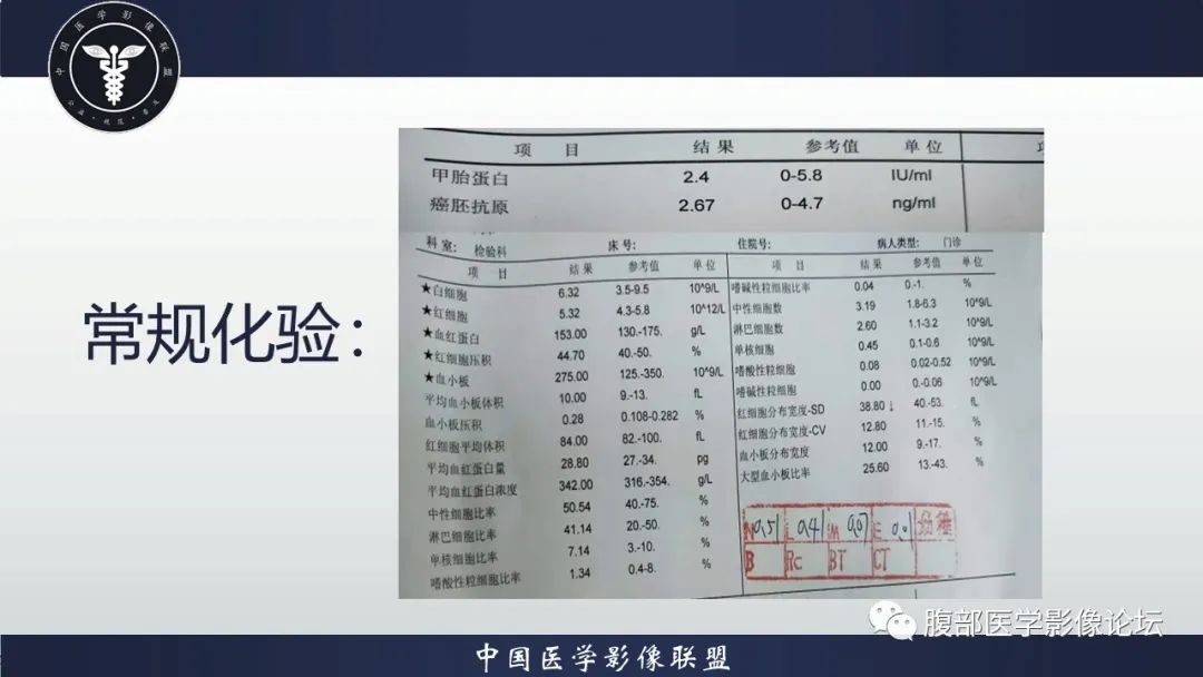 影像PPT - 【病例】十二指肠神经内分泌肿瘤伴肝转移1例CT影像-3 影像PPT - 【病例】十二指肠神经内分泌肿瘤伴肝转移1例CT影像-3