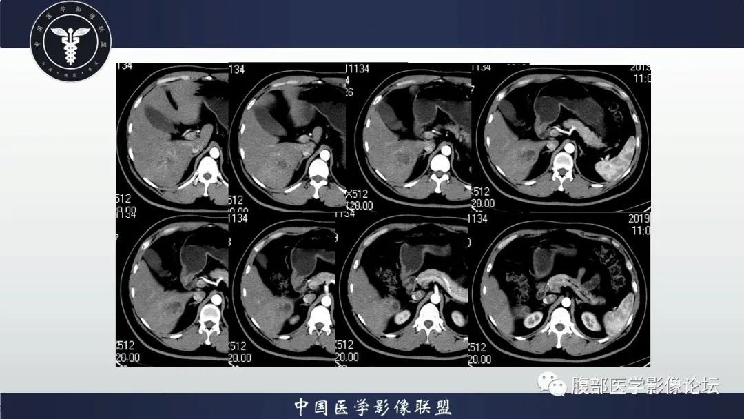 影像PPT - 【病例】十二指肠神经内分泌肿瘤伴肝转移1例CT影像-6 影像PPT - 【病例】十二指肠神经内分泌肿瘤伴肝转移1例CT影像-6