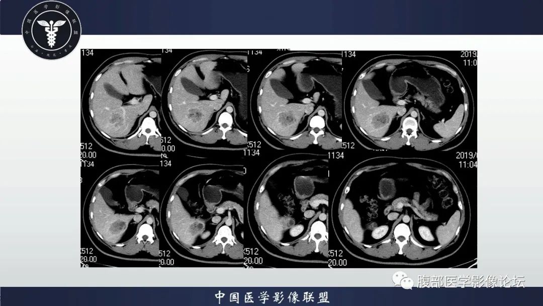 影像PPT - 【病例】十二指肠神经内分泌肿瘤伴肝转移1例CT影像-7 影像PPT - 【病例】十二指肠神经内分泌肿瘤伴肝转移1例CT影像-7