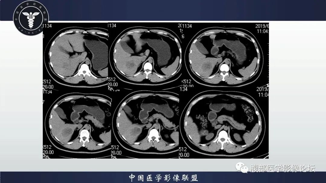 影像PPT - 【病例】十二指肠神经内分泌肿瘤伴肝转移1例CT影像-5 影像PPT - 【病例】十二指肠神经内分泌肿瘤伴肝转移1例CT影像-5
