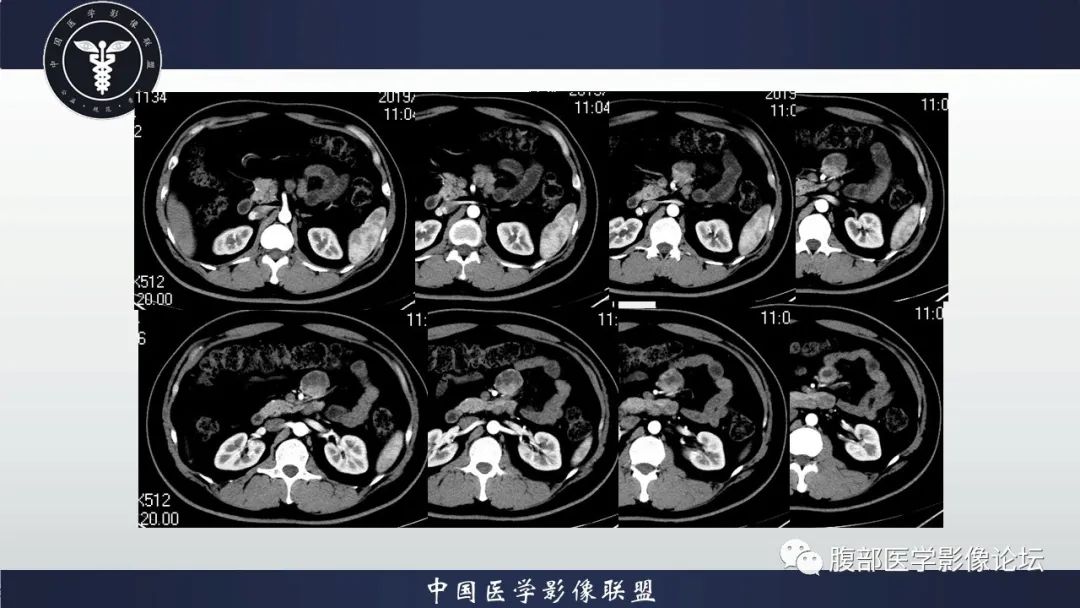 影像PPT - 【病例】十二指肠神经内分泌肿瘤伴肝转移1例CT影像-11 影像PPT - 【病例】十二指肠神经内分泌肿瘤伴肝转移1例CT影像-11