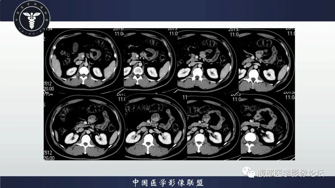 影像PPT - 【病例】十二指肠神经内分泌肿瘤伴肝转移1例CT影像-12 影像PPT - 【病例】十二指肠神经内分泌肿瘤伴肝转移1例CT影像-12