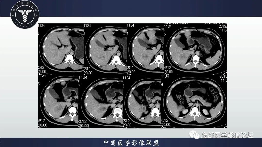 影像PPT - 【病例】十二指肠神经内分泌肿瘤伴肝转移1例CT影像-8 影像PPT - 【病例】十二指肠神经内分泌肿瘤伴肝转移1例CT影像-8