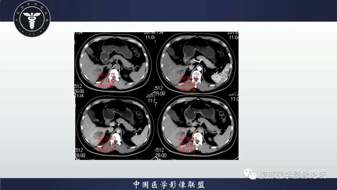 影像PPT - 【病例】十二指肠神经内分泌肿瘤伴肝转移1例CT影像-9 影像PPT - 【病例】十二指肠神经内分泌肿瘤伴肝转移1例CT影像-9