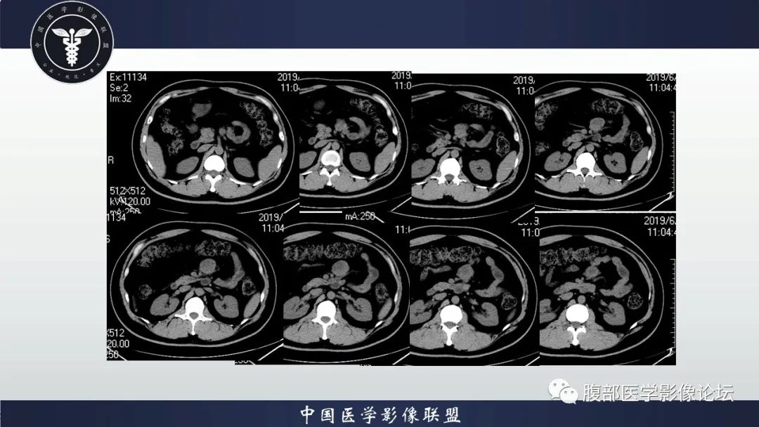 影像PPT - 【病例】十二指肠神经内分泌肿瘤伴肝转移1例CT影像-10 影像PPT - 【病例】十二指肠神经内分泌肿瘤伴肝转移1例CT影像-10