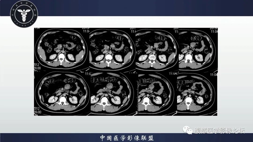影像PPT - 【病例】十二指肠神经内分泌肿瘤伴肝转移1例CT影像-13 影像PPT - 【病例】十二指肠神经内分泌肿瘤伴肝转移1例CT影像-13