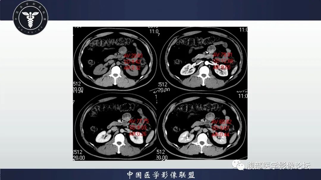 影像PPT - 【病例】十二指肠神经内分泌肿瘤伴肝转移1例CT影像-14 影像PPT - 【病例】十二指肠神经内分泌肿瘤伴肝转移1例CT影像-14