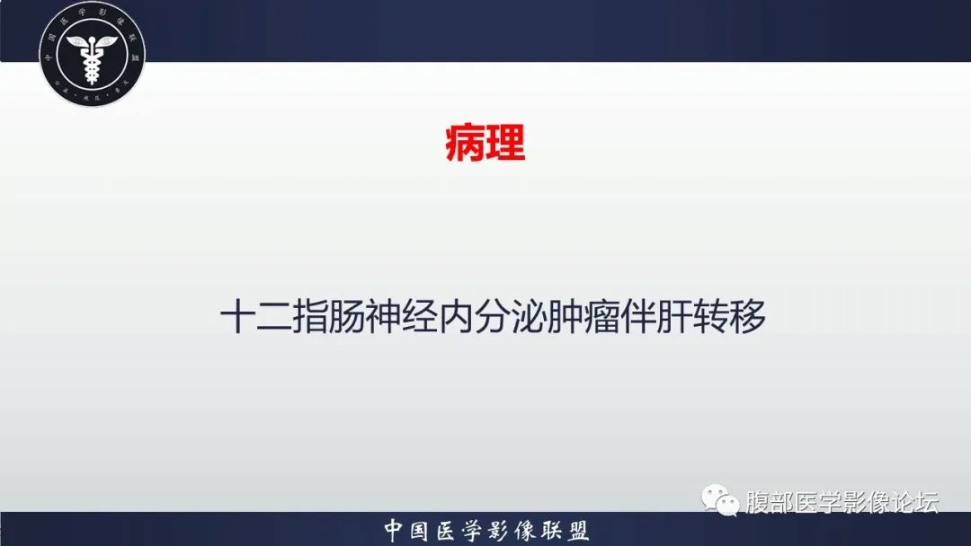 影像PPT - 【病例】十二指肠神经内分泌肿瘤伴肝转移1例CT影像-15 影像PPT - 【病例】十二指肠神经内分泌肿瘤伴肝转移1例CT影像-15